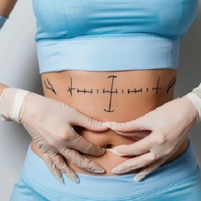 Liposuction: The Smart Choice for Stubborn Fat