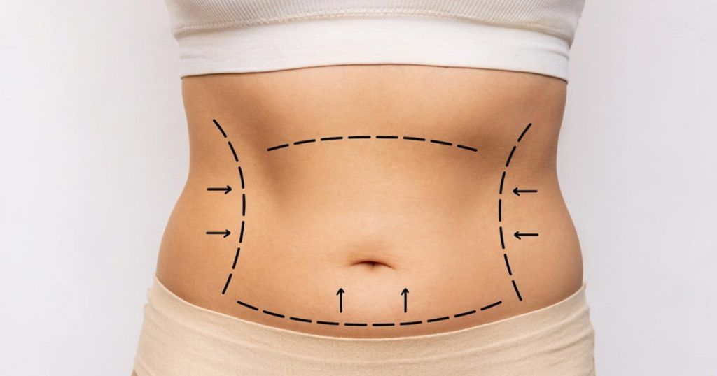 Top Benefits of Tummy Tuck Surgery Beyond a Flat Stomach